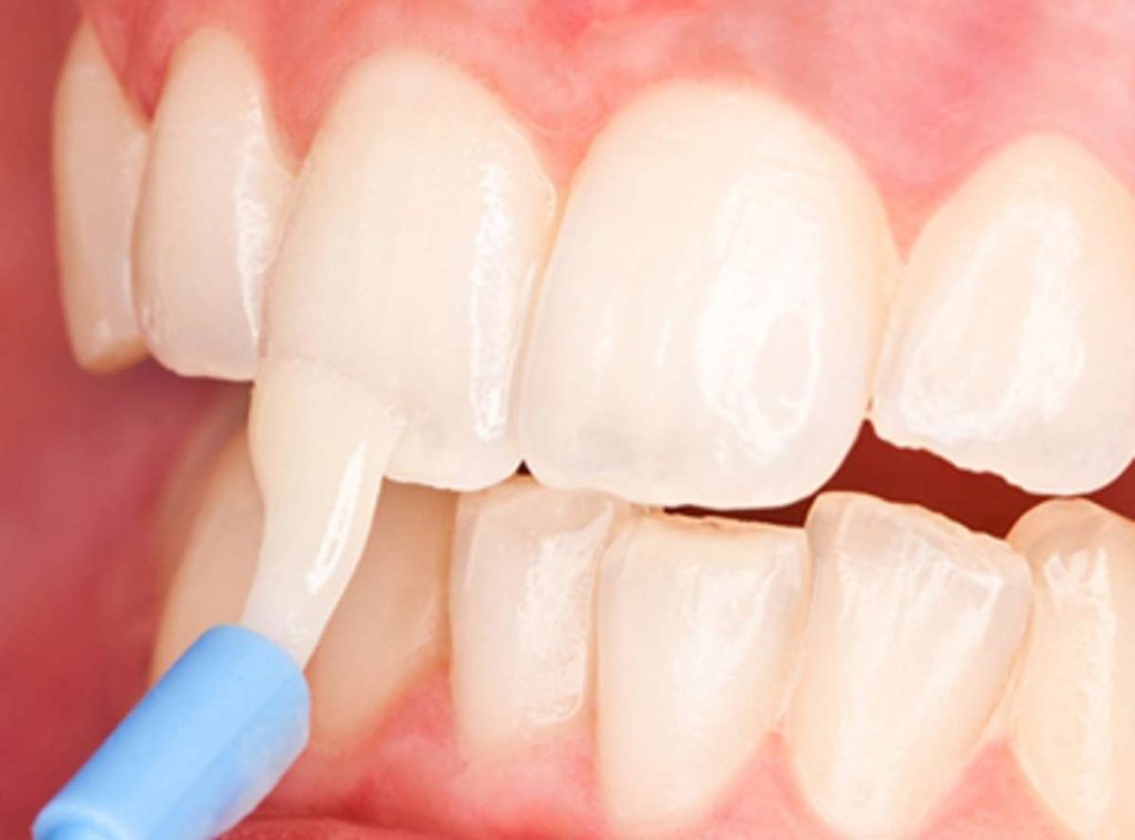 All About Fluoride Treatment For Cavity Prevention